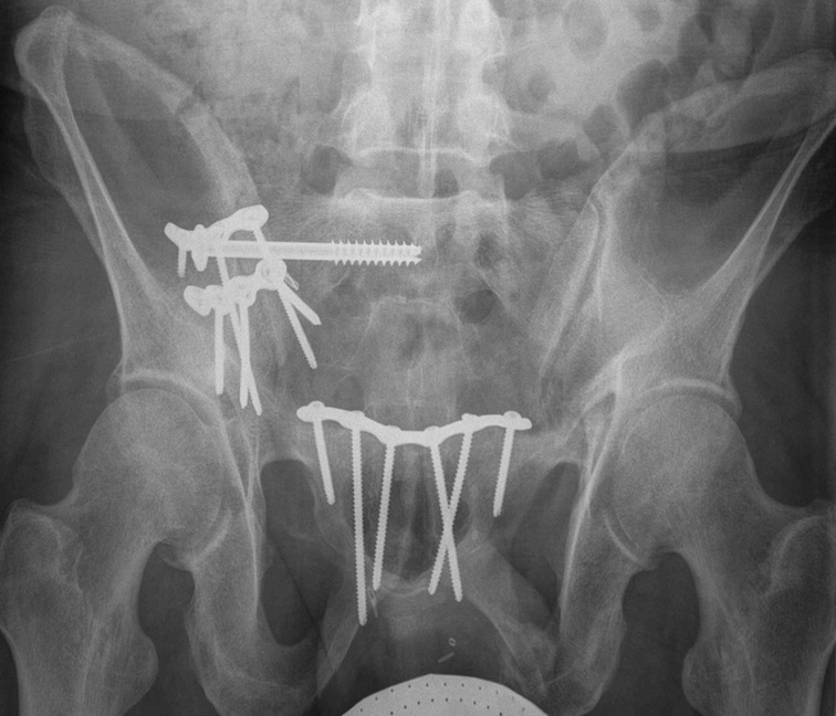 Pelvis Anterior Sacroiliac Plate 2